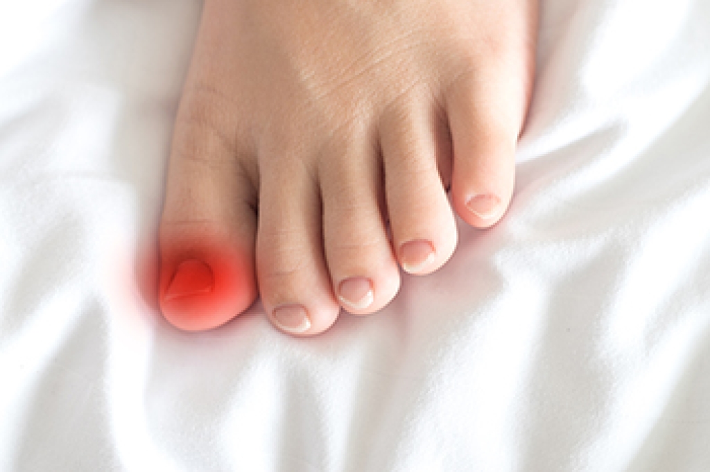How Ingrown Toenails Progress