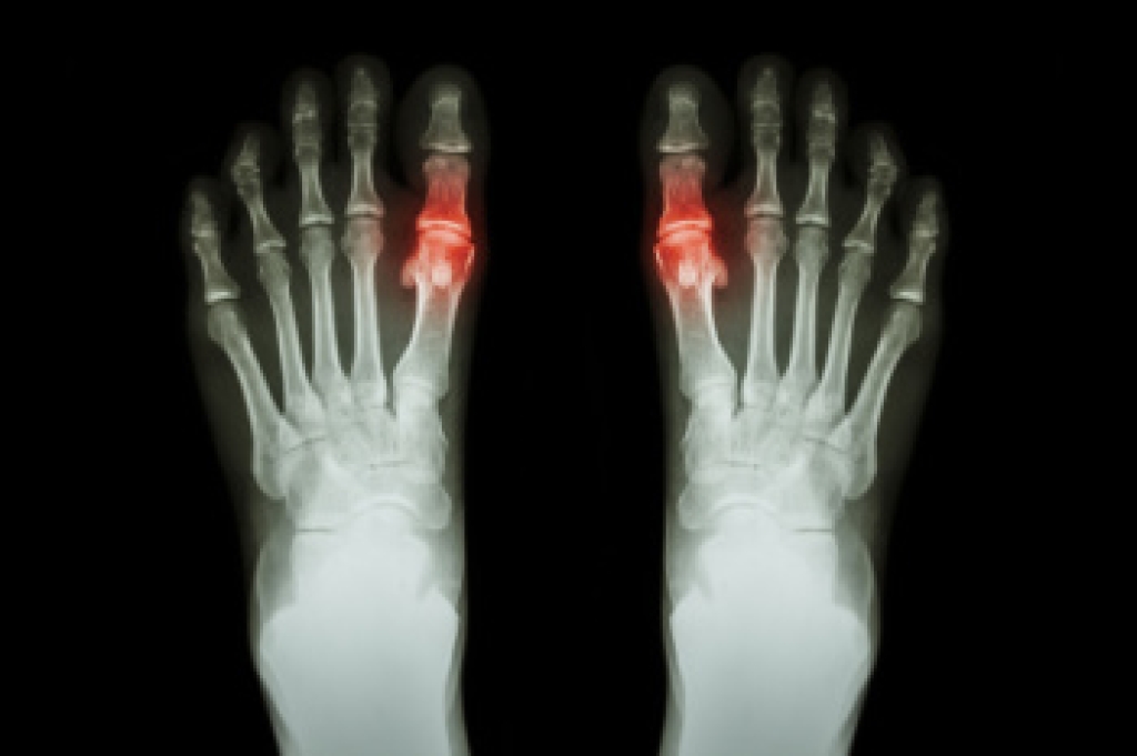 Gout and the Big Toe